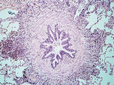 Histological section of an airway from someone who died of an acute asthma attack. The airway is almost completely obstructed due to contraction of the bronchial smooth muscle and the lumen is further